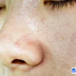 close komedo kulit kusam